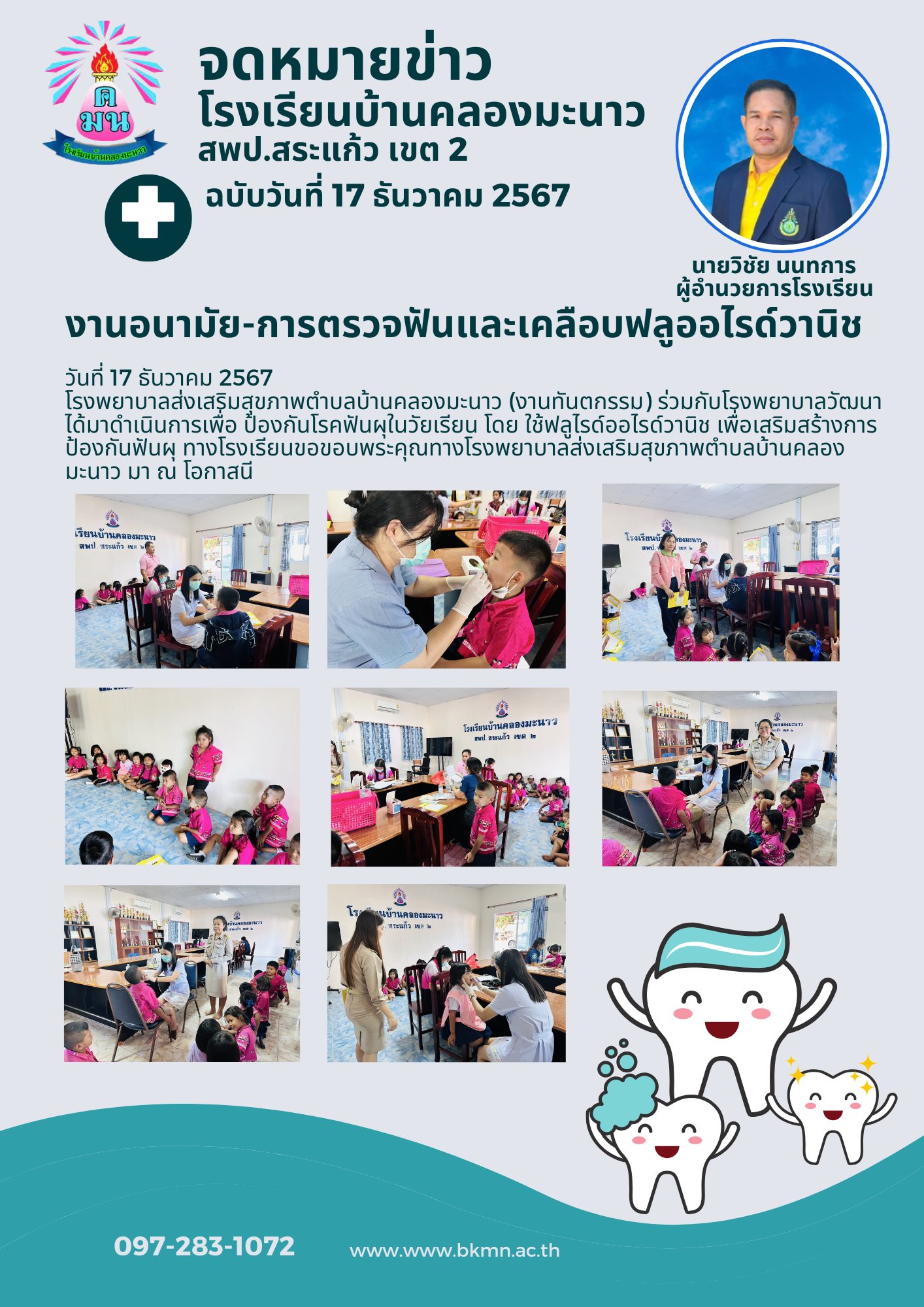 เคลือบฟลูไรด์ออไรด์วานิช เพื่อเสริมสร้างการป้องกันฟันผุ